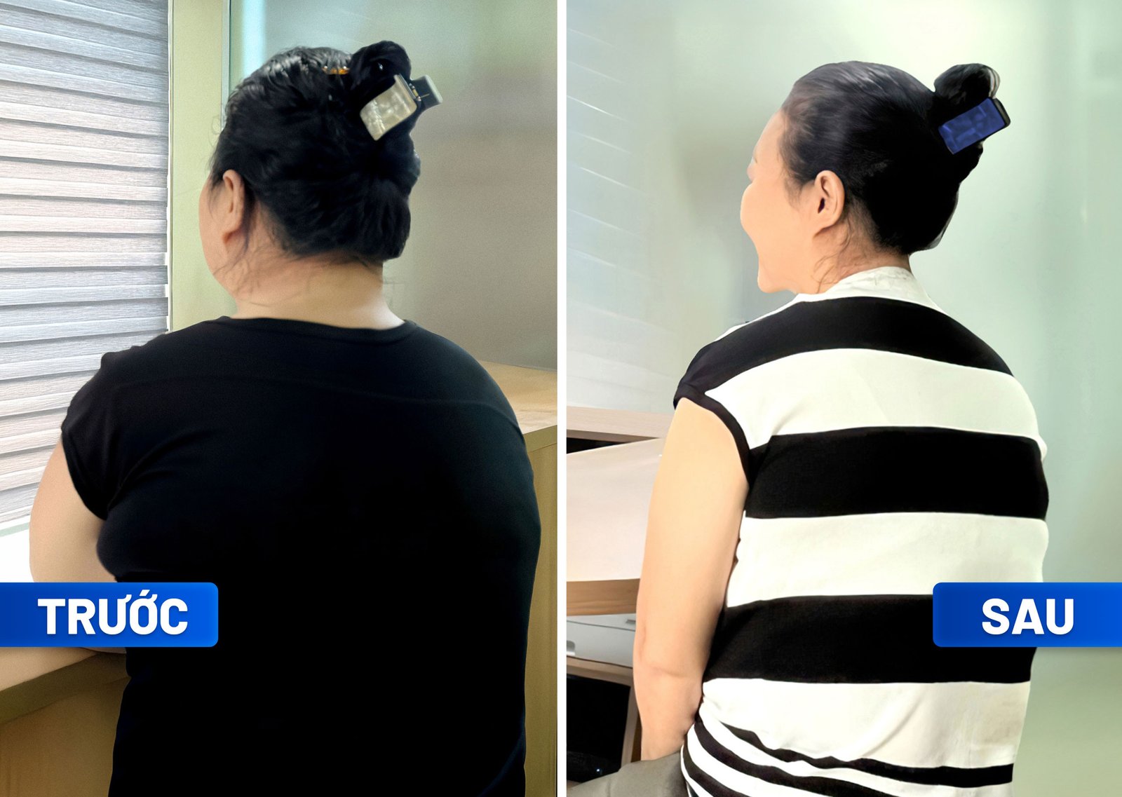 Bà Chea giảm cân thành công, thoát nguy cơ phẫu thuật khớp gối