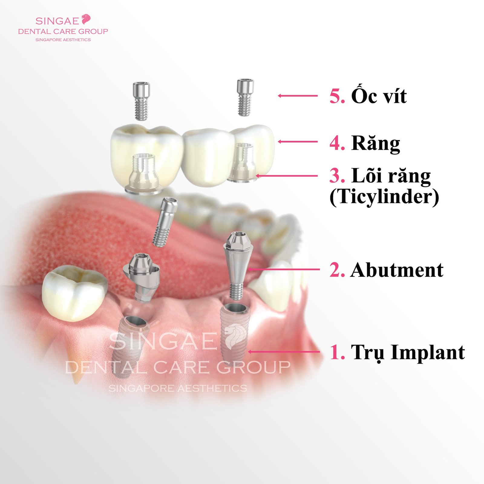 Cấu tạo chi tiết một trụ Implant nha khoa và các thành phần chính, minh họa cho chất lượng dịch vụ nha khoa Singae