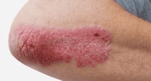 Gel nha đam tự nhiên giúp làm dịu và hỗ trợ điều trị các vấn đề da như vảy nến, minh họa lợi ích của nhớt nha đam