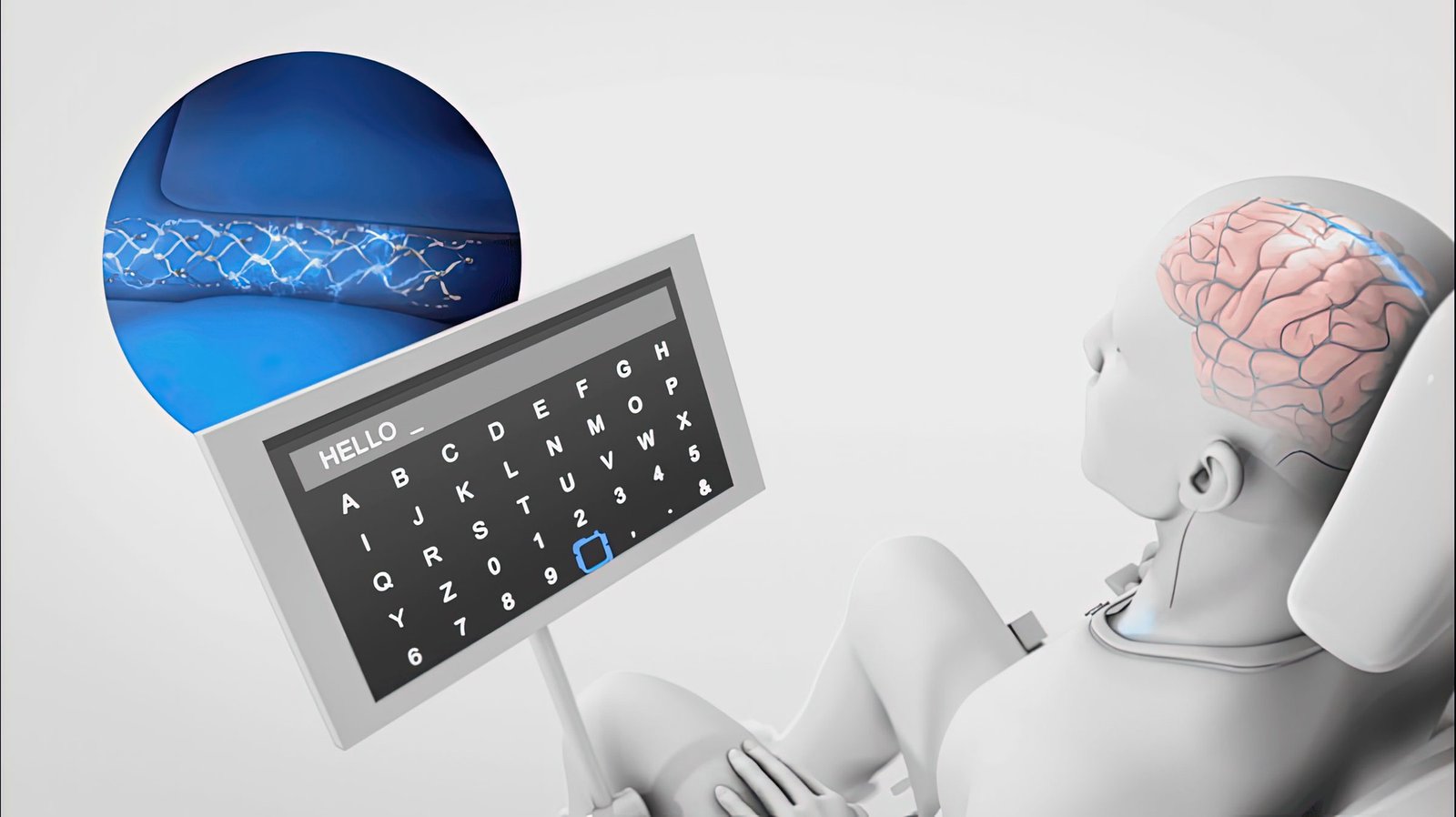 Minh họa thiết bị Stentrode của Synchron cấy ghép qua mạch máu